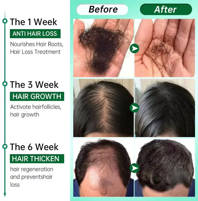 Spray rapide pour la croissance des cheveux au gingembre, Anti-chute des racines, sérum pour la repousse des cheveux, réparation endommagée du cuir chevelu, produits de soins nourrissants pour femmes et hommes