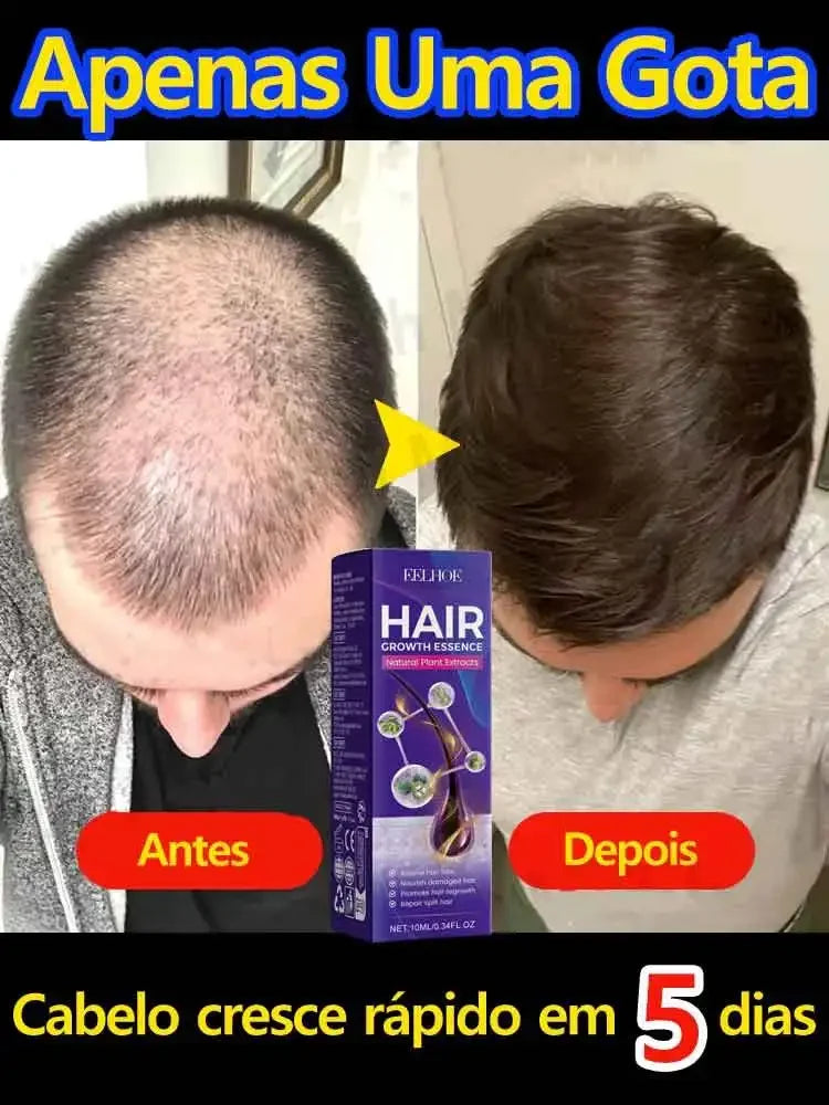 Réparation efficace de la perte d'huile de croissance des cheveux perte de cheveux génétique perte de cheveux post-partum séborrhéique