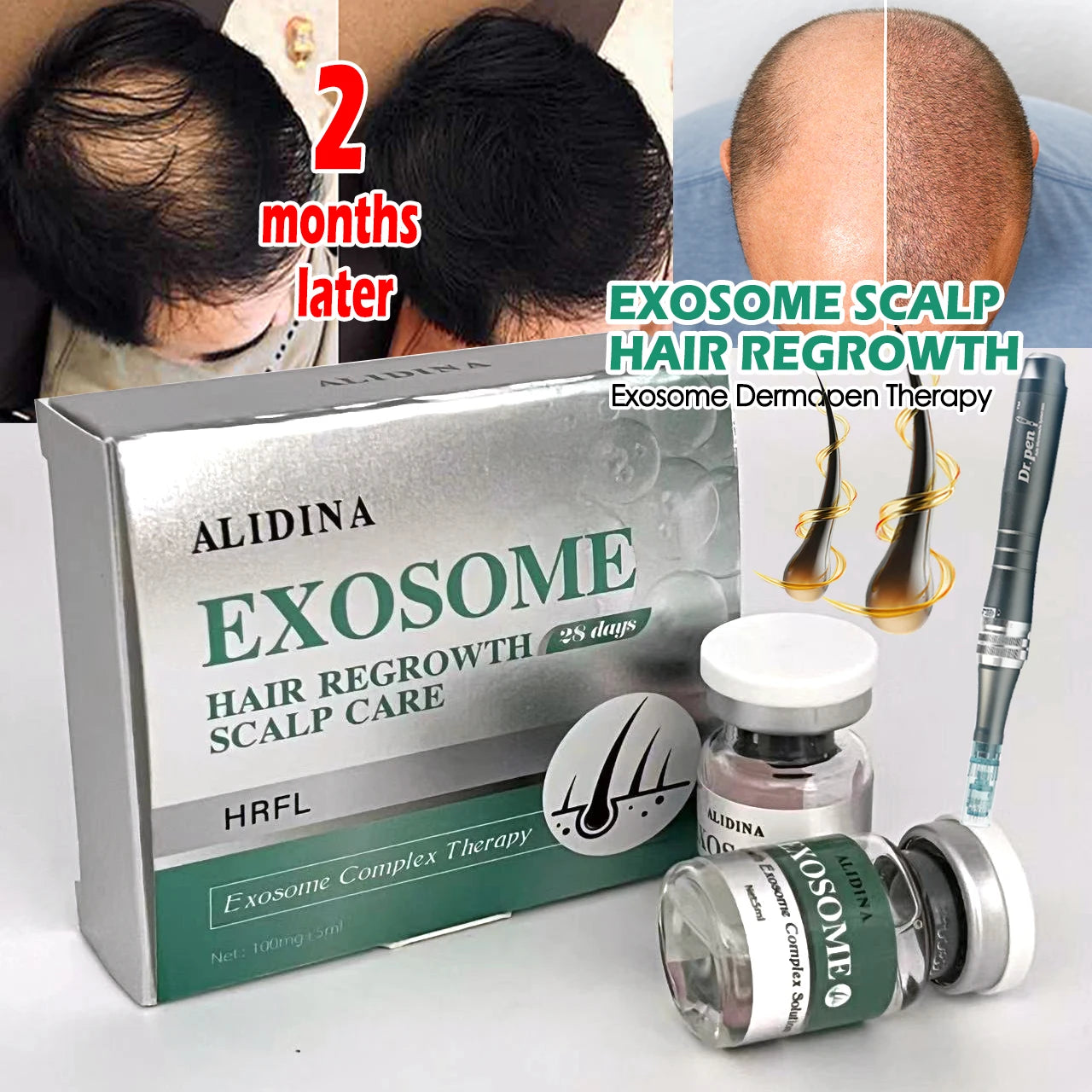 GD Le sérum essentiel pour la croissance des cheveux à l'exosomes Bio-scalp le plus efficace en 2025. efficace pour réparer la calvitie et la repousse des cheveux