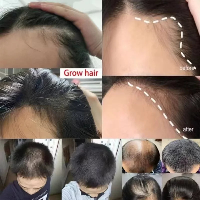 Spray rapide pour la croissance des cheveux au gingembre, Anti-chute des racines, sérum pour la repousse des cheveux, réparation endommagée du cuir chevelu, produits de soins nourrissants pour femmes et hommes