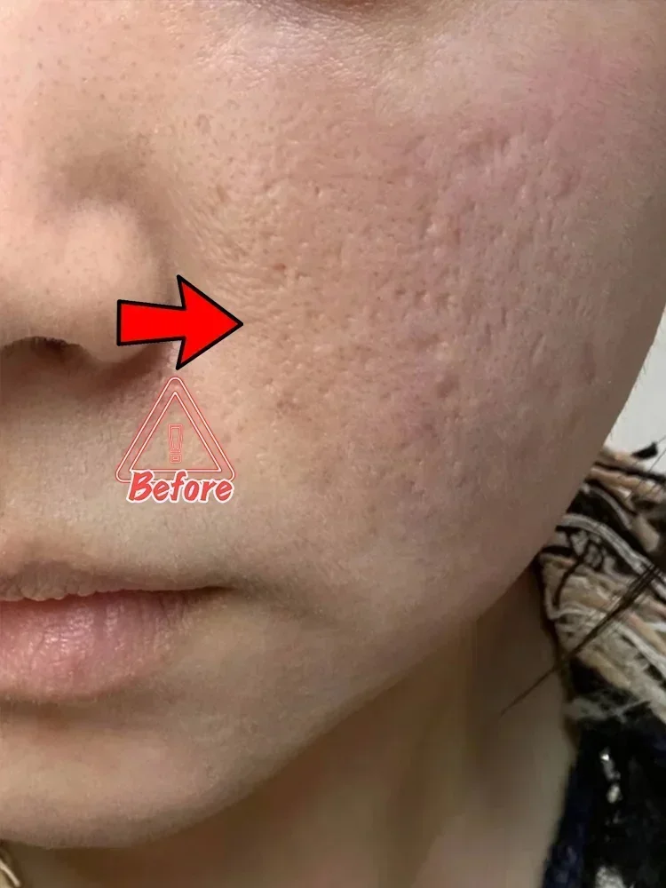 Crème réparatrice de trous pour hommes, Anti-acné, estompe pour éliminer les marques d'acné, estompe les cicatrices, remplissage, gel de régénération
