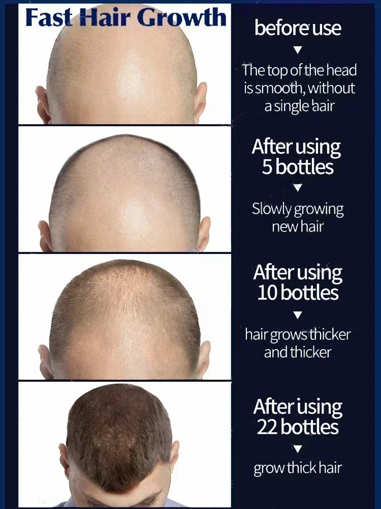 Réparation efficace de la perte d'huile de croissance des cheveux perte de cheveux génétique perte de cheveux post-partum séborrhéique
