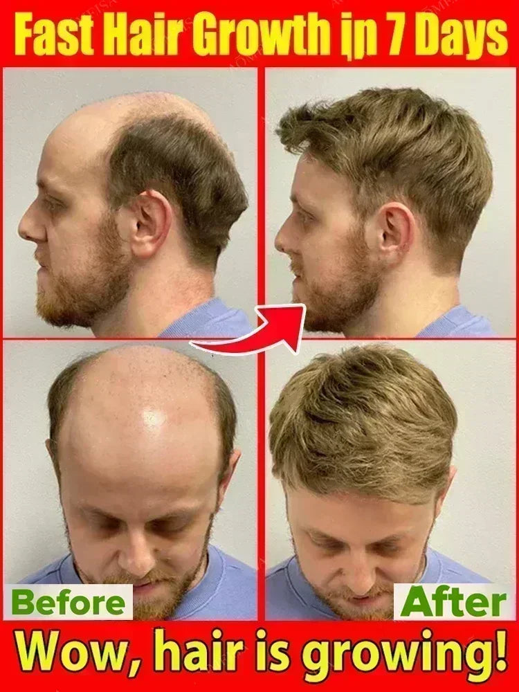 Réparation efficace de la perte d'huile de croissance des cheveux perte de cheveux génétique perte de cheveux post-partum séborrhéique