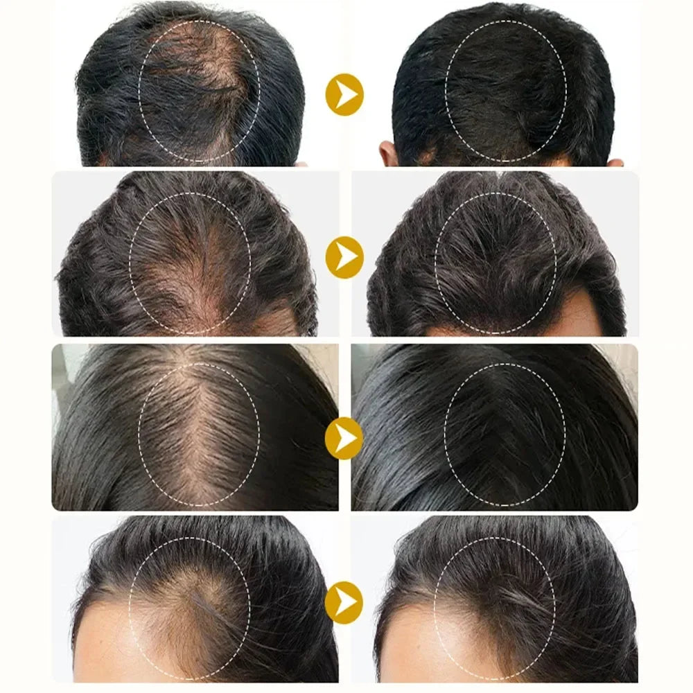 Spray rapide pour la croissance des cheveux au gingembre, Anti-chute des racines, sérum pour la repousse des cheveux, réparation endommagée du cuir chevelu, produits de soins nourrissants pour femmes et hommes