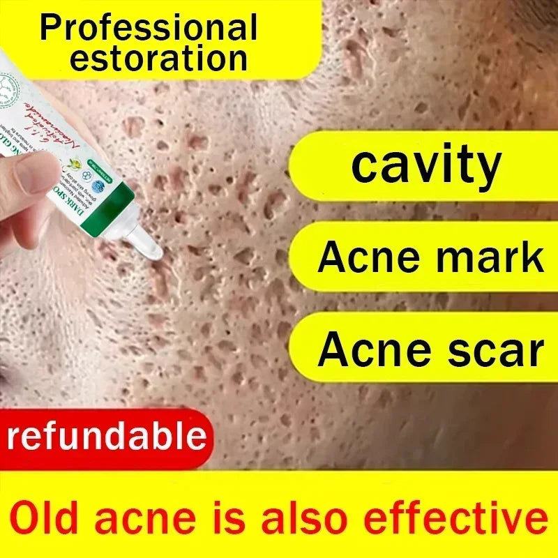 Crème réparatrice de trous pour hommes, Anti-acné, estompe pour éliminer les marques d'acné, estompe les cicatrices, remplissage, gel de régénération